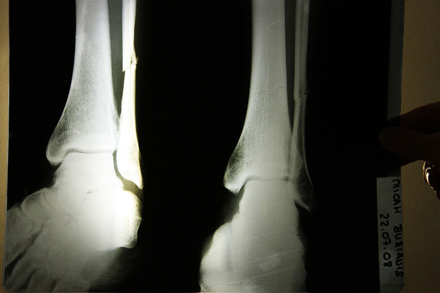 F08 ls Micah's X-ray Micah's X-ray