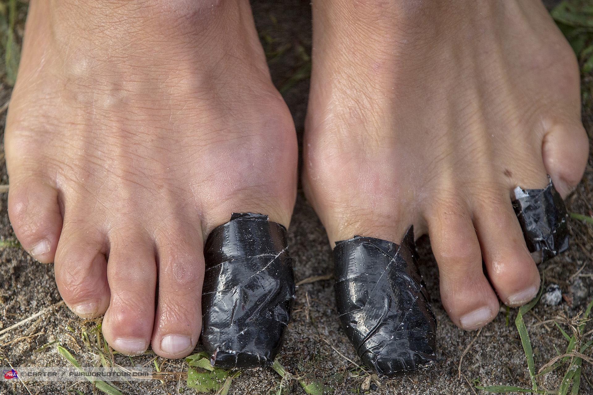 Steve Allen battle scars